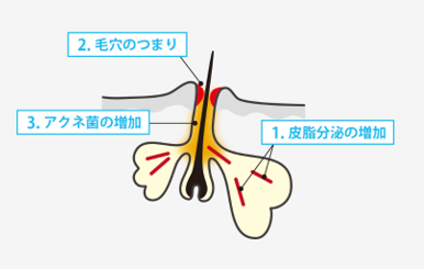 ニキビ